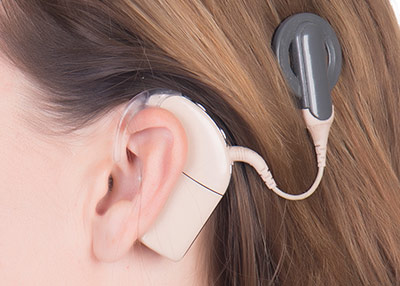 cochlear-implant-los-angeles