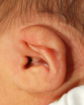 Cup ear (photo courtesy of Becon Medical)