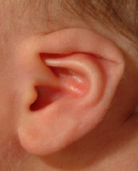 Lidding or Lop ear (photo courtesy of Becon Medical)