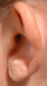 Prominent/protruding ear