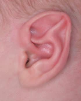 Stahl’s ear (aka Elf ear or Spock ear)