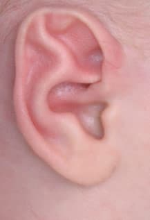 Stahl’s Ear at birth